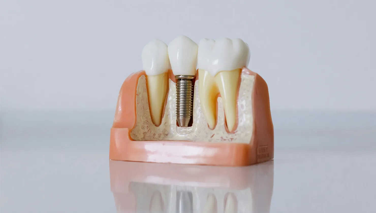 Imagen detalle de un molde para observar como es un implante dental