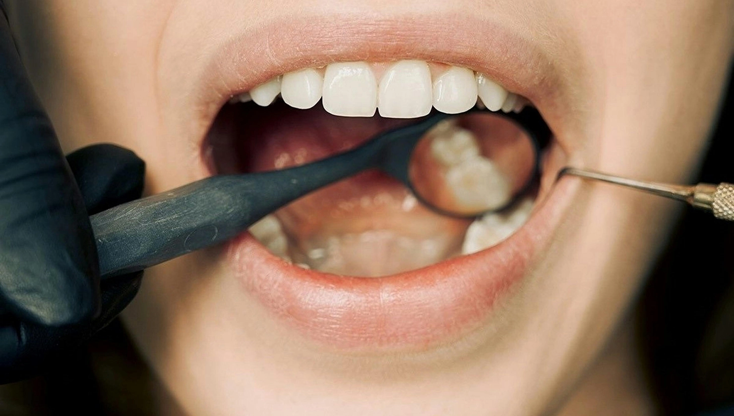 Imatge d’una boca oberta mentre un dentista observa les dents per detectar possibles taques dentals o canvis de color.