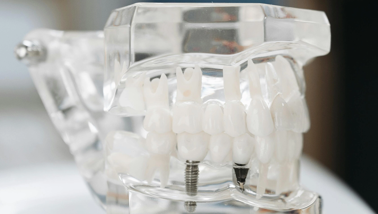 Imatge d’una maqueta dental que mostra com queden col·locats els implants dentals a l’os maxil·lar, permetent visualitzar el resultat abans de realitzar el tractament.