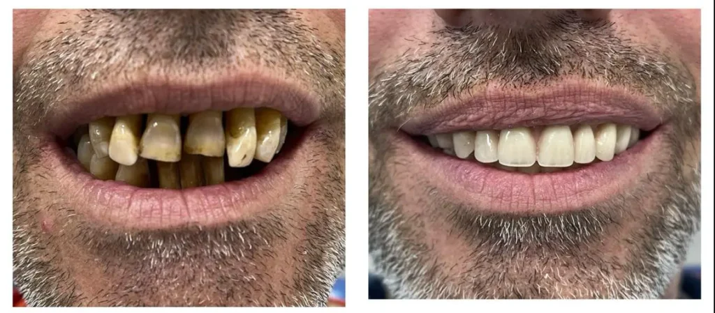 Imagen de la mejora de un cliente de Clínica Dental Vilà