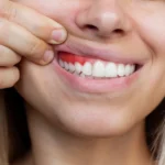 Noia mostrant genives inflamades i sagnat per gingivitis a Vilanova del Camí