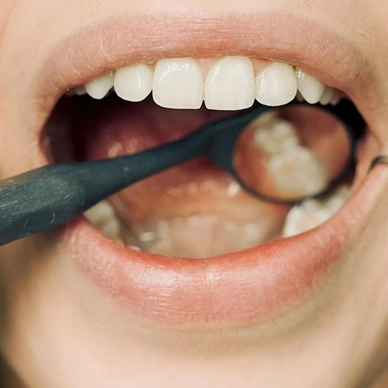 Imatge d’una boca oberta mentre un dentista observa les dents per detectar possibles taques dentals o canvis de color.