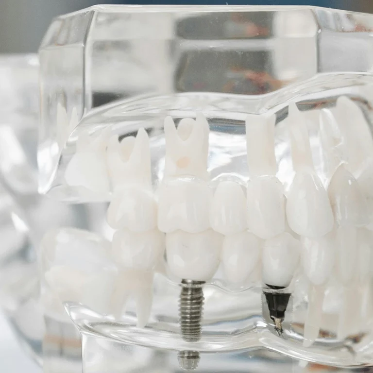 Imatge d’una maqueta dental que mostra com queden col·locats els implants dentals a l’os maxil·lar, permetent visualitzar el resultat abans de realitzar el tractament.