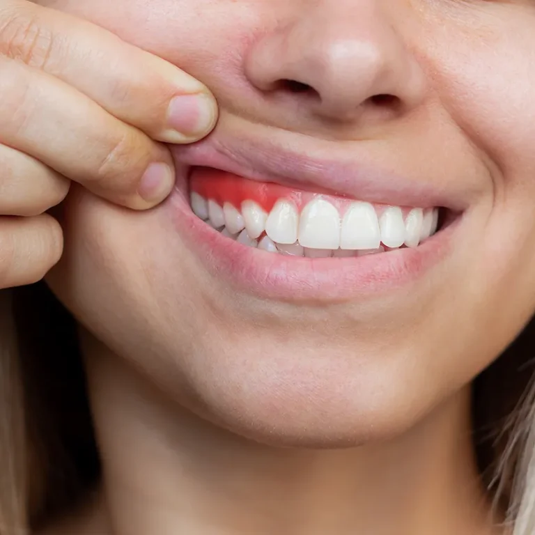 Noia mostrant genives inflamades i sagnat per gingivitis a Vilanova del Camí