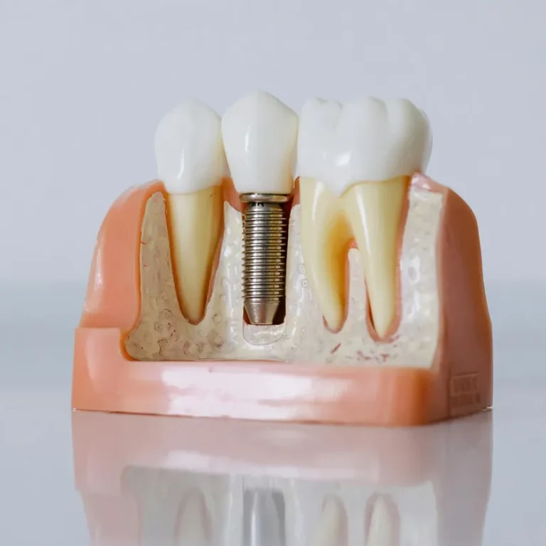 Imagen detalle de un molde para observar como es un implante dental